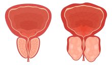 REZUM ou HoLEP Qual a melhor cirurgia para a hiperplasia prostática benigna (HPB)