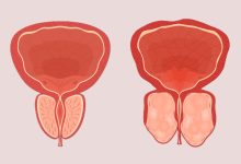 Por que a enucleação prostática tem ganhado espaço como alternativa moderna para tratar o crescimento benigno da próstata