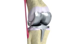Prótese total de joelho quando esse tratamento é indicado