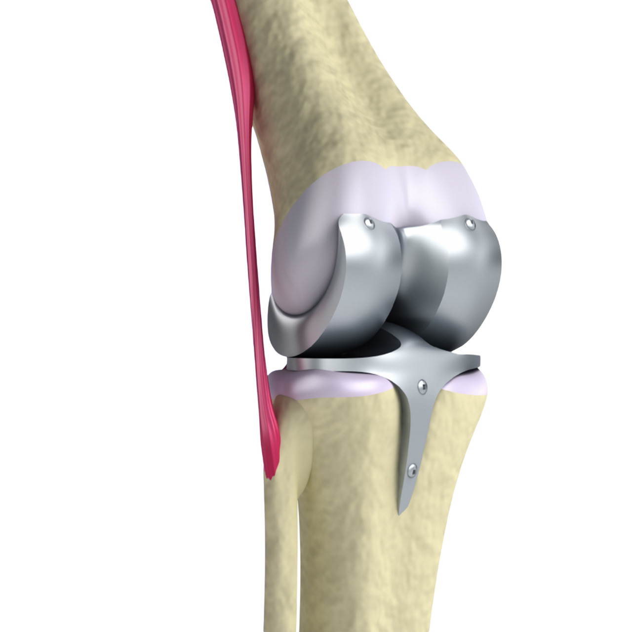 Prótese total de joelho quando esse tratamento é indicado