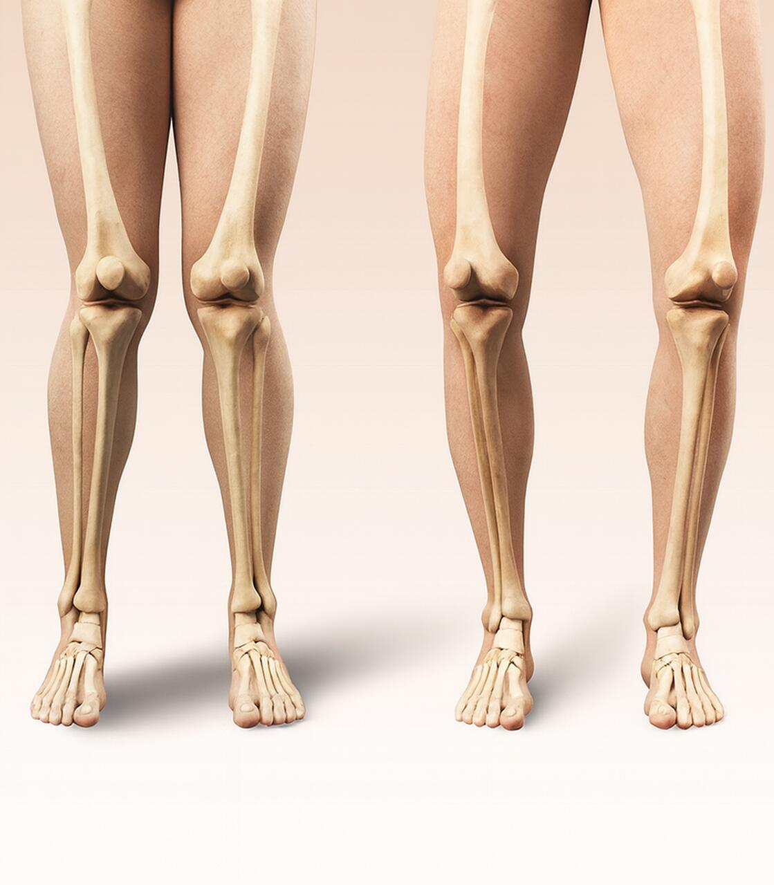 Seus joelhos estão alinhados Veja o que o formato das suas pernas pode revelar