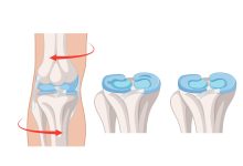 Dor, estalos e travamento no joelho Pode ser lesão no menisco