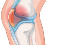 Dor na frente do joelho Pode ser condropatia patelar