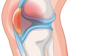 Dor na frente do joelho Pode ser condropatia patelar