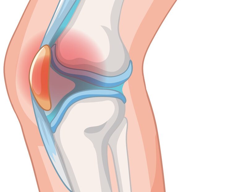 Dor na frente do joelho Pode ser condropatia patelar