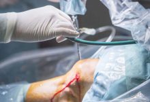 Sutura do menisco quando ela é indicada