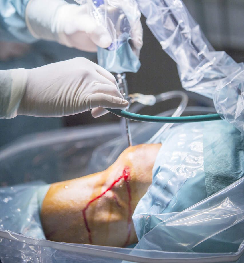 Sutura do menisco quando ela é indicada