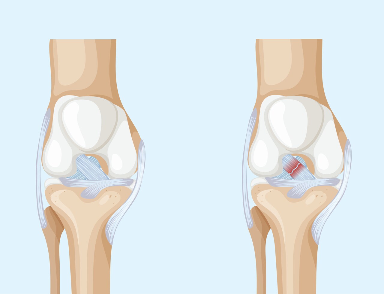 Lesão do LCA o problema que pode estar no seu joelho sem você saber