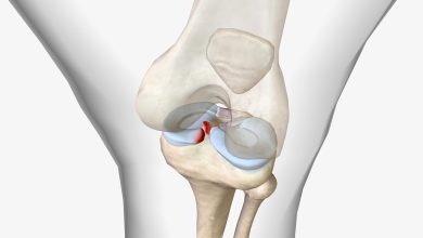 Lesionou o menisco Entenda a diferença entre os tipos de lesão